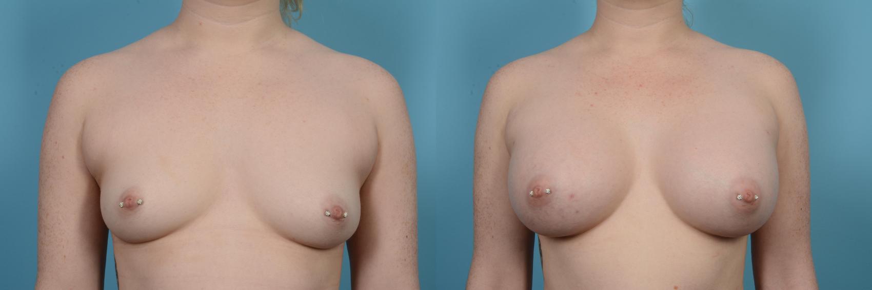 Before & After Breast Augmentation by Dr. Mustoe Case 516 View #1 View in Chicago, IL