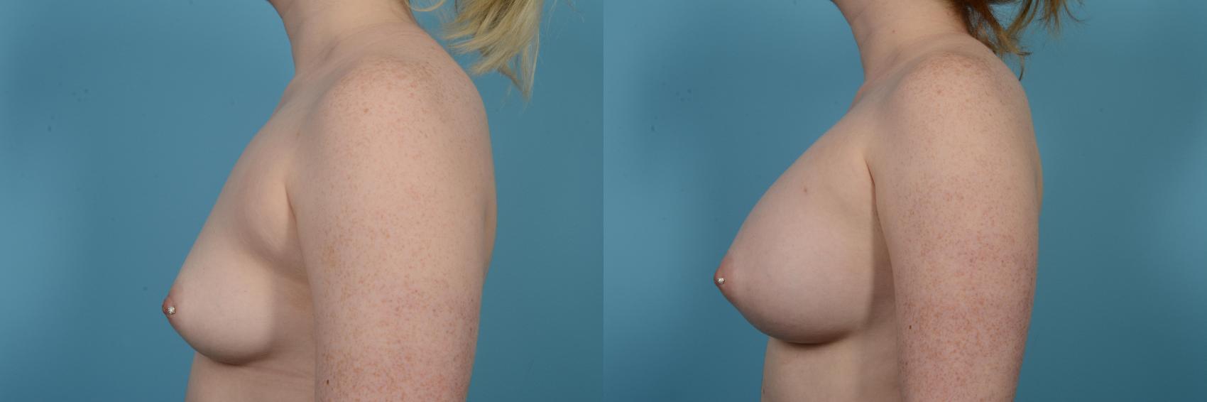 Before & After Breast Augmentation by Dr. Mustoe Case 516 View #2 View in Chicago, IL