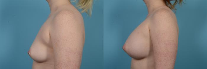 Before & After Breast Augmentation by Dr. Mustoe Case 516 View #2 View in Chicago, IL