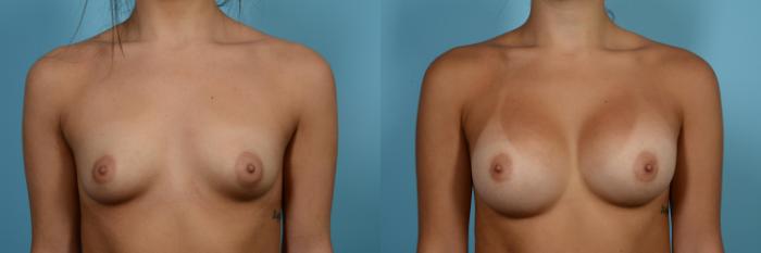 Before & After Breast Augmentation by Dr. Mustoe Case 541 View #1 View in Chicago, IL