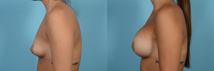 Before & After Breast Augmentation by Dr. Mustoe Case 541 View #2 View in Chicago, IL