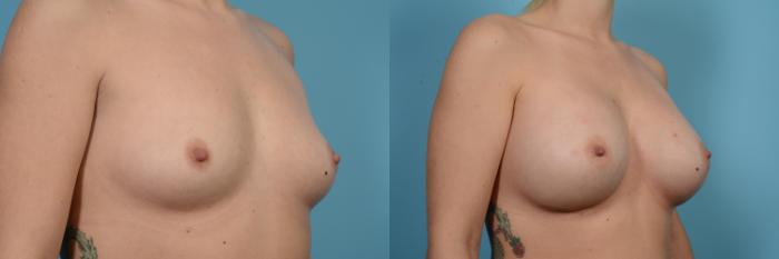 Before & After Breast Augmentation by Dr. Mustoe Case 557 View #3 View in Chicago, IL