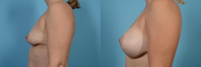 Before & After Breast Augmentation by Dr. Mustoe Case 567 View #2 View in Chicago, IL