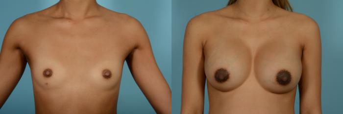 Before & After Breast Augmentation by Dr. Mustoe Case 823 Front View in Chicago, IL