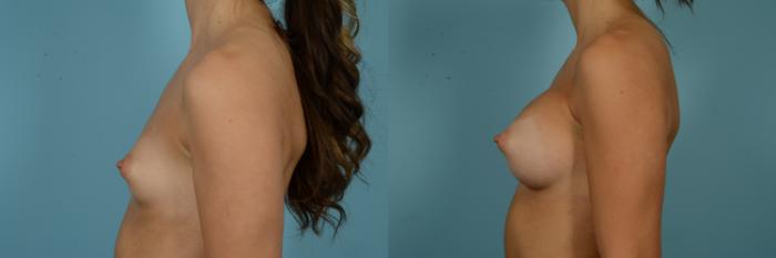 Before & After Breast Augmentation by Dr. Mustoe Case 837 Left Side View in Chicago, IL