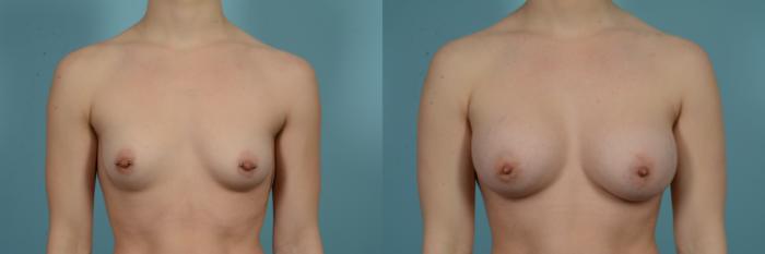 Before & After Breast Augmentation by Dr. Mustoe Case 978 Front View in Chicago, IL