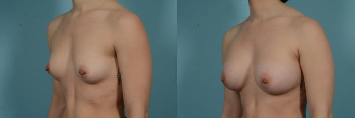 Before & After Breast Augmentation by Dr. Mustoe Case 978 Left Oblique View in Chicago, IL