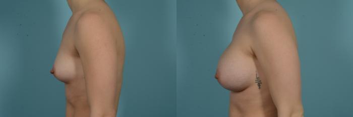 Before & After Breast Augmentation by Dr. Mustoe Case 978 Left Side View in Chicago, IL