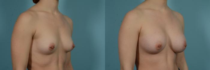 Before & After Breast Augmentation by Dr. Mustoe Case 978 Right Oblique View in Chicago, IL