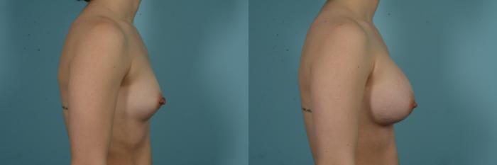 Before & After Breast Augmentation by Dr. Mustoe Case 978 Right Side View in Chicago, IL