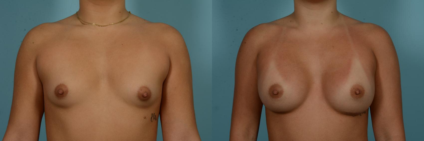 Before & After Breast Augmentation by Dr. Mustoe Case 980 Front View in Chicago, IL