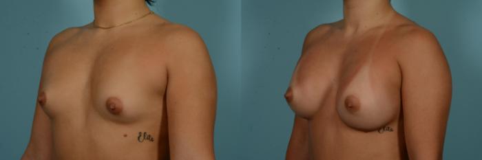 Before & After Breast Augmentation by Dr. Mustoe Case 980 Left Oblique View in Chicago, IL