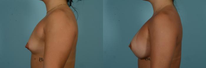 Before & After Breast Augmentation by Dr. Mustoe Case 980 Left Side View in Chicago, IL