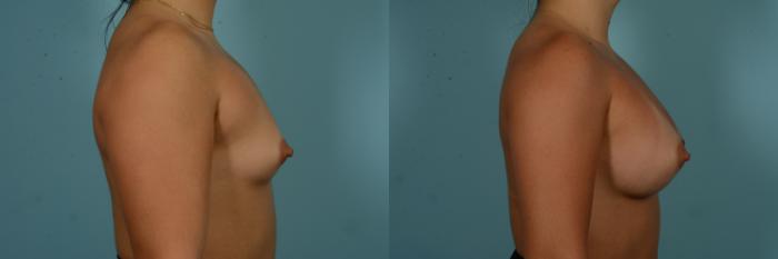 Before & After Breast Augmentation by Dr. Mustoe Case 980 Right Side View in Chicago, IL