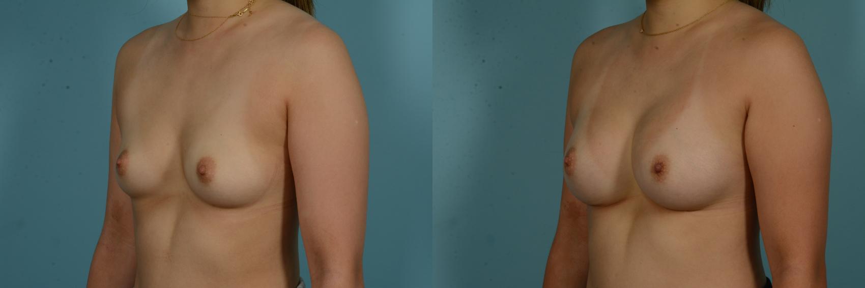 Before & After Breast Augmentation by Dr. Sinno Case 1044 Left Oblique View in Chicago, IL
