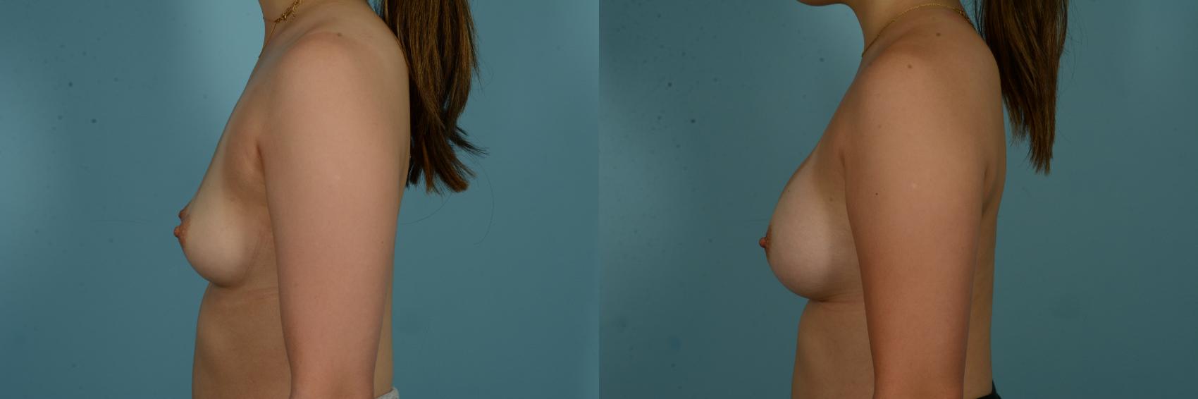 Before & After Breast Augmentation by Dr. Sinno Case 1044 Left Side View in Chicago, IL