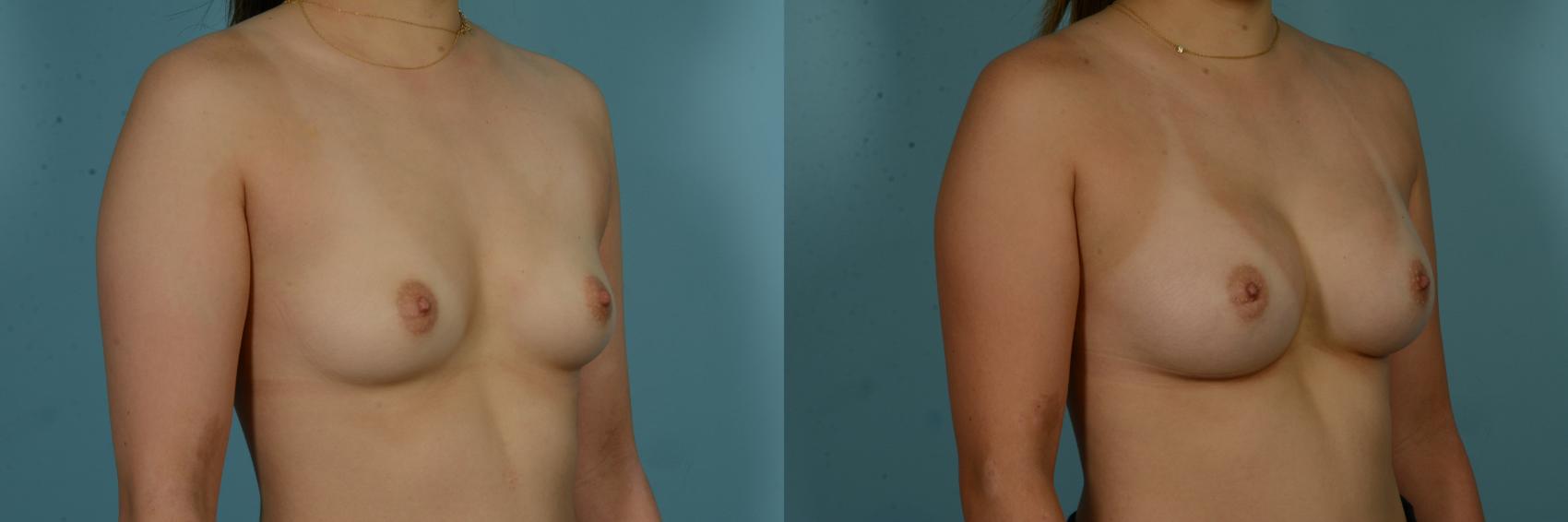 Before & After Breast Augmentation by Dr. Sinno Case 1044 Right Oblique View in Chicago, IL