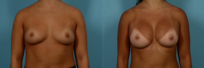 Before & After Breast Augmentation by Dr. Sinno Case 1094 Front View in Chicago, IL
