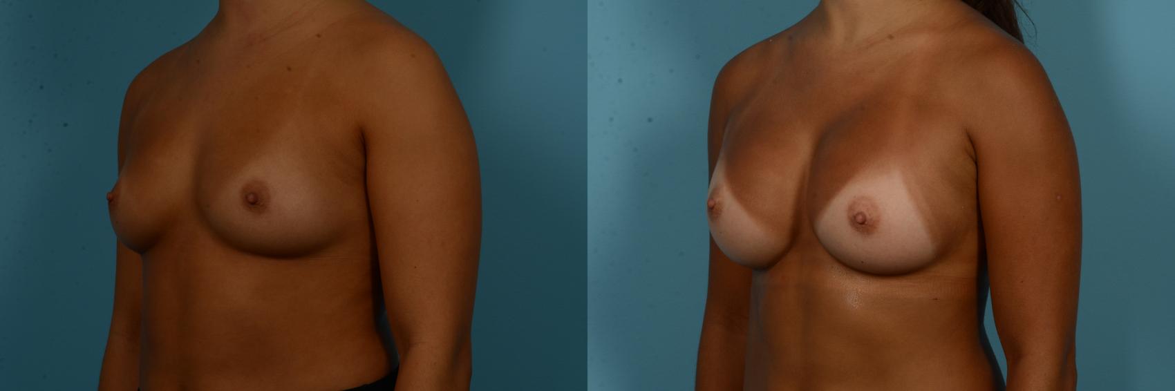 Before & After Breast Augmentation by Dr. Sinno Case 1094 Left Oblique View in Chicago, IL