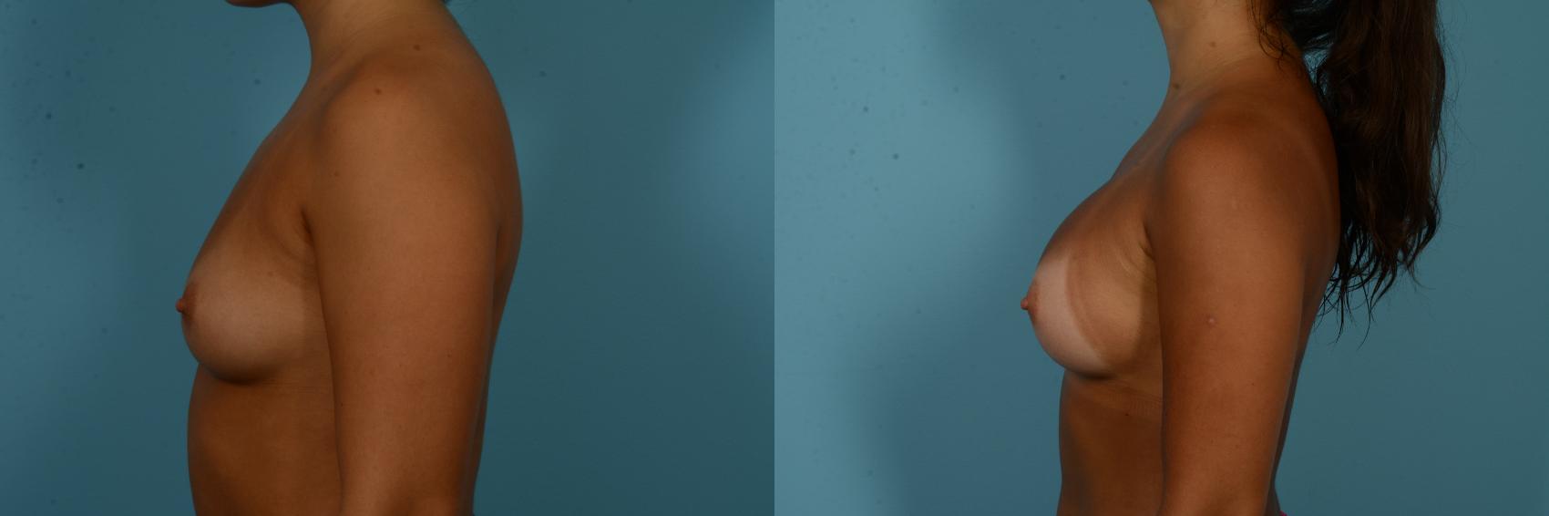 Before & After Breast Augmentation by Dr. Sinno Case 1094 Left Side View in Chicago, IL