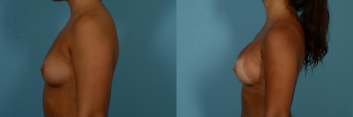 Before & After Breast Augmentation by Dr. Sinno Case 1094 Left Side View in Chicago, IL