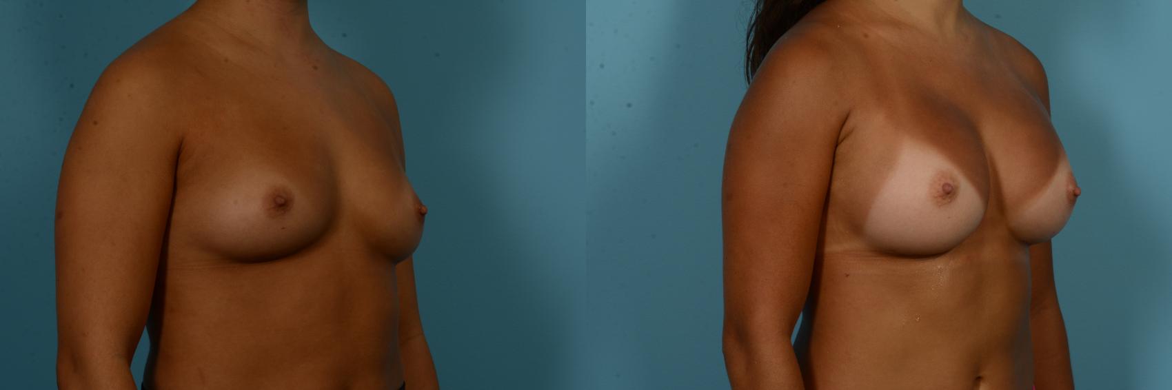 Before & After Breast Augmentation by Dr. Sinno Case 1094 Right Oblique View in Chicago, IL