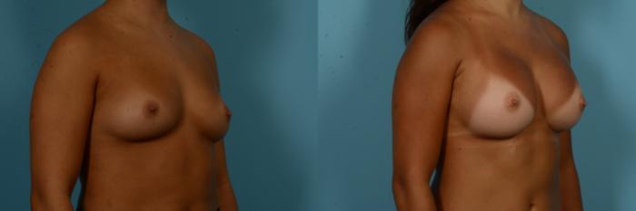 Before & After Breast Augmentation by Dr. Sinno Case 1094 Right Oblique View in Chicago, IL