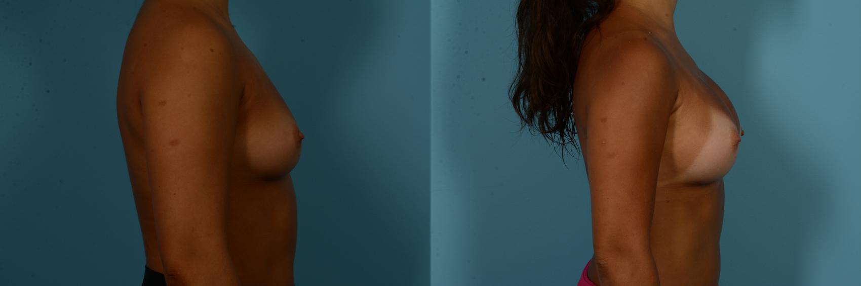 Before & After Breast Augmentation by Dr. Sinno Case 1094 Right Side View in Chicago, IL