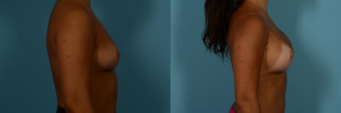 Before & After Breast Augmentation by Dr. Sinno Case 1094 Right Side View in Chicago, IL