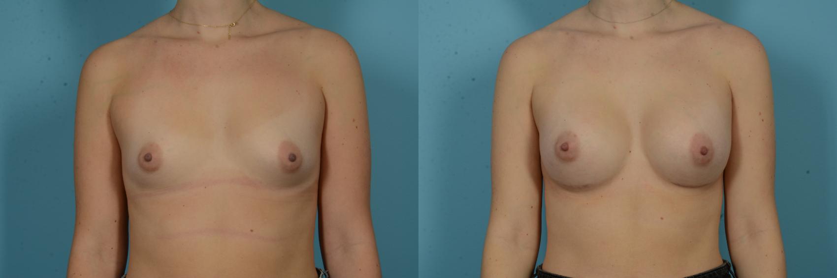 Before & After Breast Augmentation by Dr. Sinno Case 1115 Front View in Chicago, IL