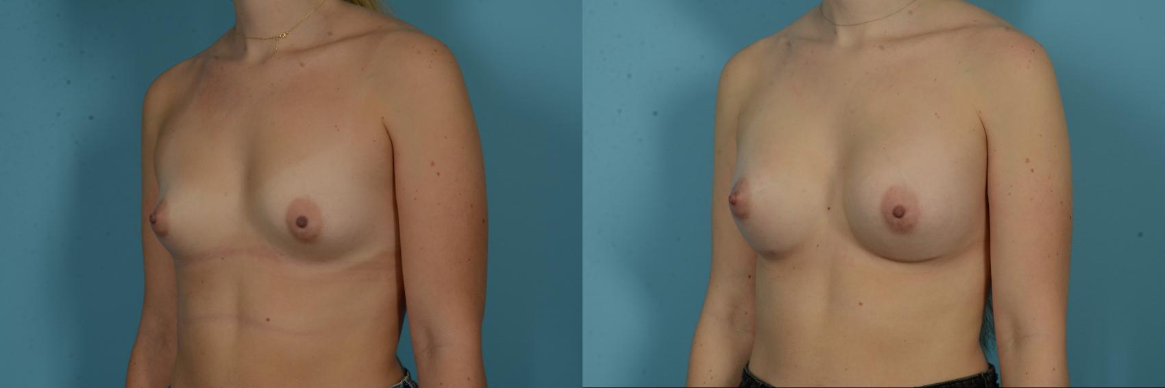 Before & After Breast Augmentation by Dr. Sinno Case 1115 Left Oblique View in Chicago, IL
