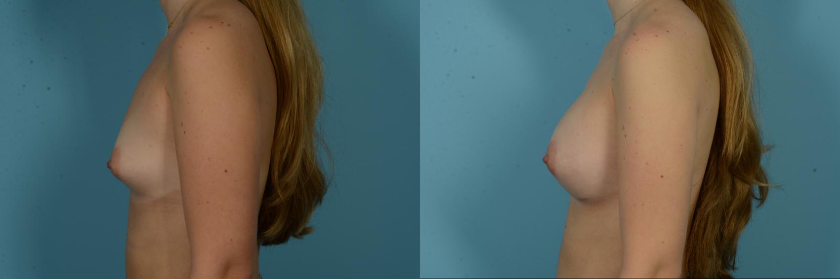 Before & After Breast Augmentation by Dr. Sinno Case 1115 Left Side View in Chicago, IL