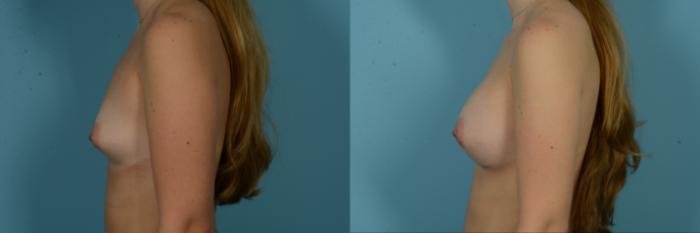 Before & After Breast Augmentation by Dr. Sinno Case 1115 Left Side View in Chicago, IL