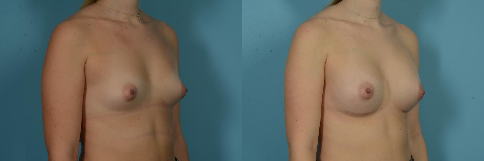 Before & After Breast Augmentation by Dr. Sinno Case 1115 Right Oblique View in Chicago, IL
