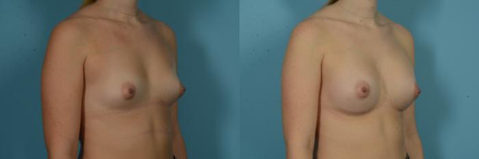 Before & After Breast Augmentation by Dr. Sinno Case 1115 Right Oblique View in Chicago, IL