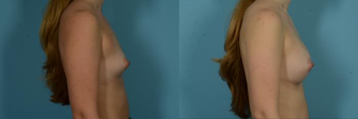 Before & After Breast Augmentation by Dr. Sinno Case 1115 Right Side View in Chicago, IL