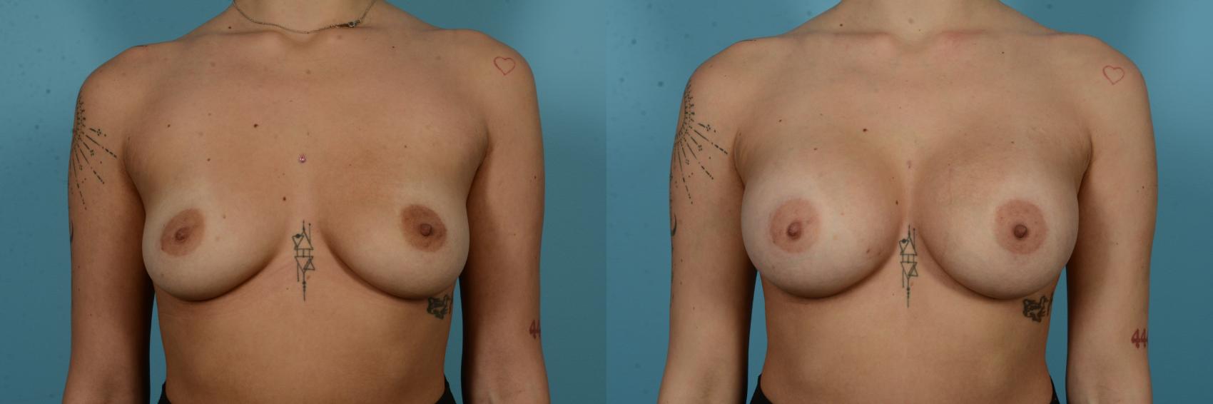 Before & After Breast Augmentation by Dr. Sinno Case 1125 Front View in Chicago, IL