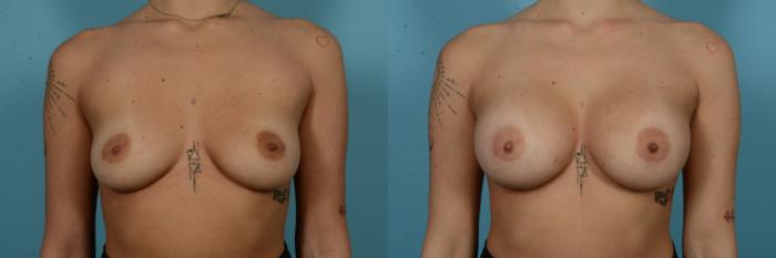 Before & After Breast Augmentation by Dr. Sinno Case 1125 Front View in Chicago, IL