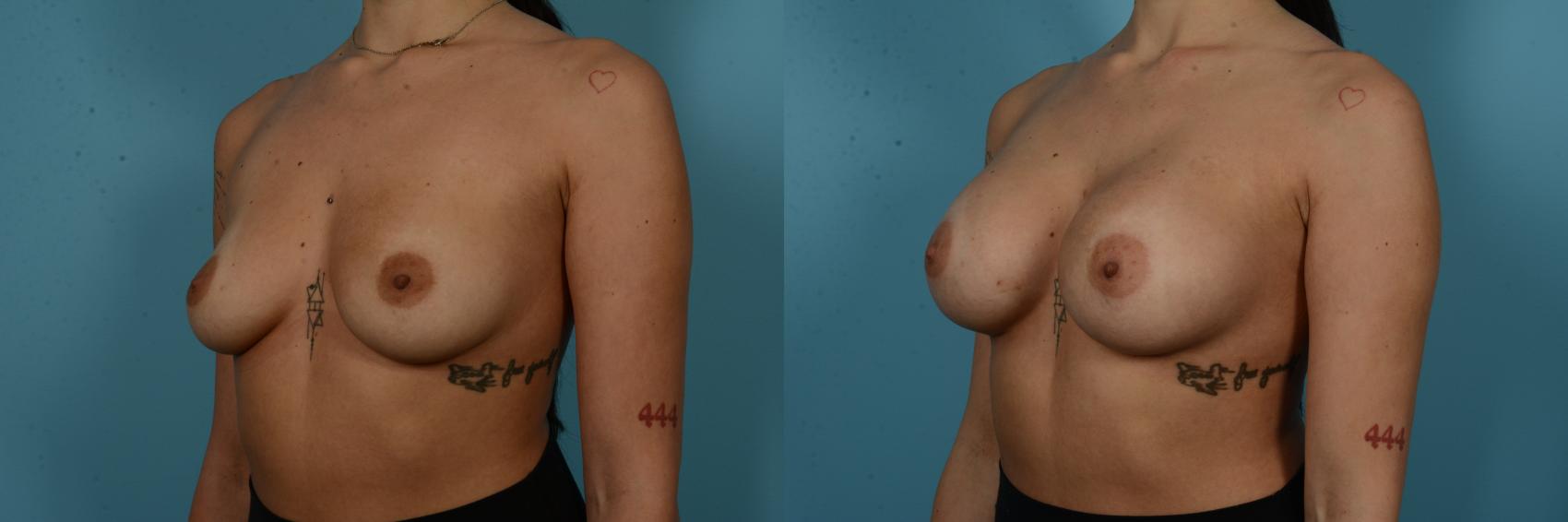 Before & After Breast Augmentation by Dr. Sinno Case 1125 Left Oblique View in Chicago, IL