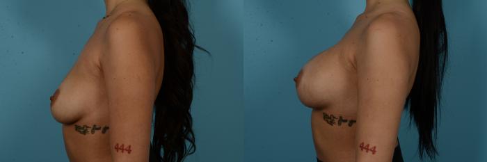 Before & After Breast Augmentation by Dr. Sinno Case 1125 Left Side View in Chicago, IL
