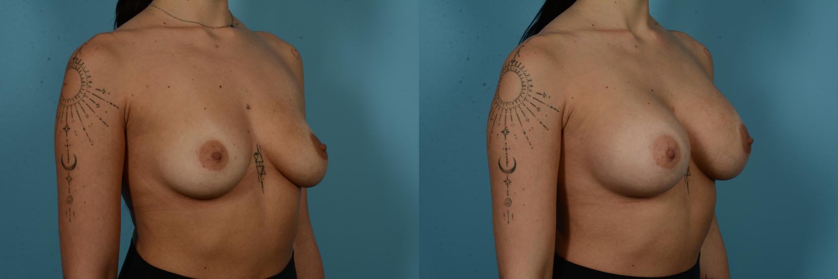 Before & After Breast Augmentation by Dr. Sinno Case 1125 Right Oblique View in Chicago, IL