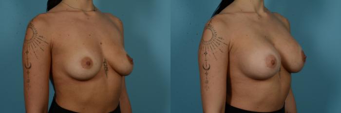 Before & After Breast Augmentation by Dr. Sinno Case 1125 Right Oblique View in Chicago, IL