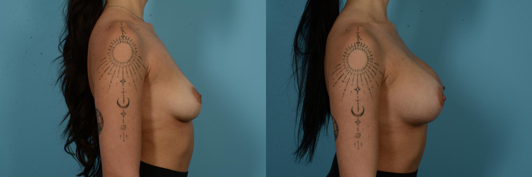 Before & After Breast Augmentation by Dr. Sinno Case 1125 Right Side View in Chicago, IL