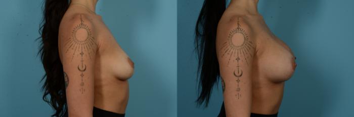Before & After Breast Augmentation by Dr. Sinno Case 1125 Right Side View in Chicago, IL