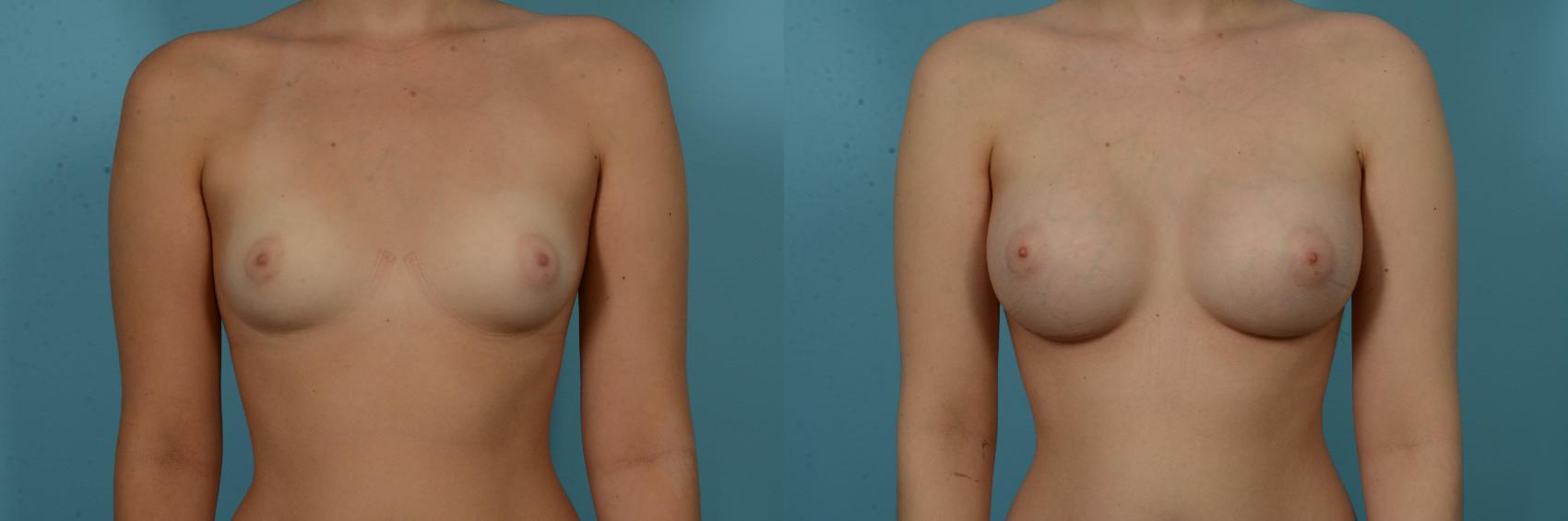 Before & After Breast Augmentation by Dr. Sinno Case 1132 Front View in Chicago, IL