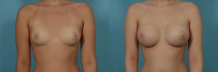 Before & After Breast Augmentation by Dr. Sinno Case 1132 Front View in Chicago, IL