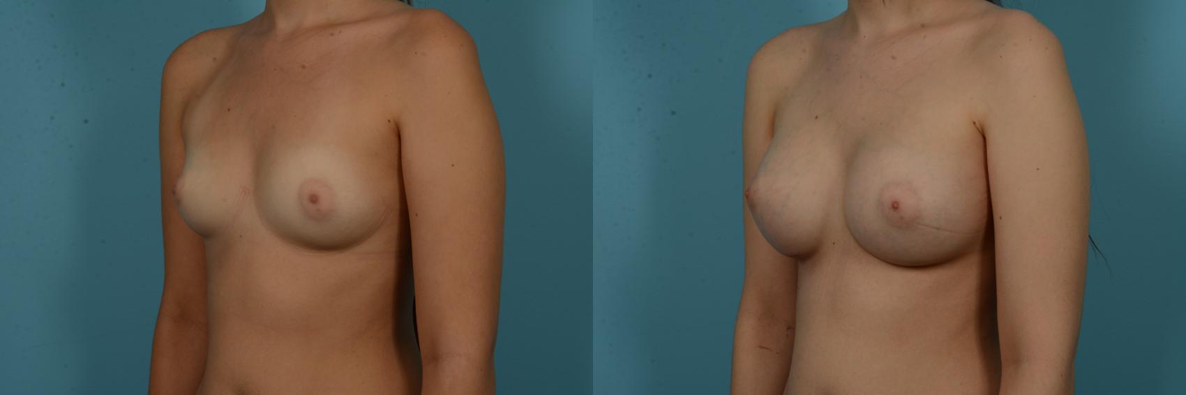 Before & After Breast Augmentation by Dr. Sinno Case 1132 Left Oblique View in Chicago, IL