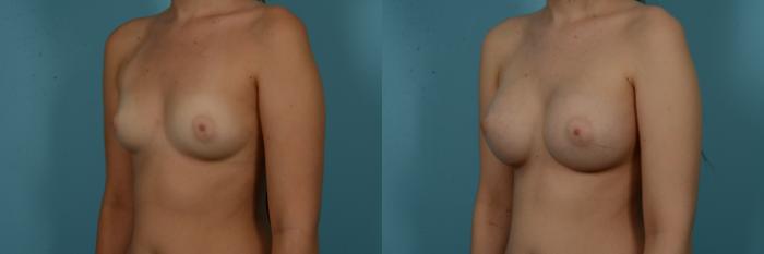Before & After Breast Augmentation by Dr. Sinno Case 1132 Left Oblique View in Chicago, IL