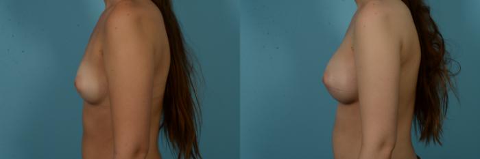 Before & After Breast Augmentation by Dr. Sinno Case 1132 Left Side View in Chicago, IL