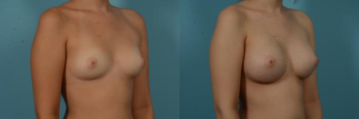 Before & After Breast Augmentation by Dr. Sinno Case 1132 Right Oblique View in Chicago, IL